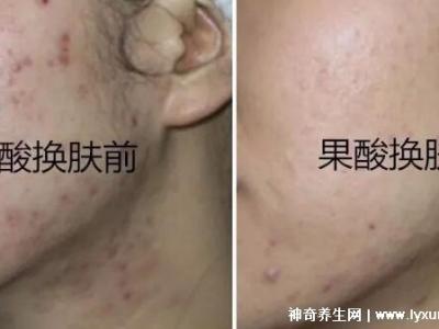 果酸換膚多少錢(qián)一次，1000-3000元不等(細(xì)致毛孔/淡化痘印)