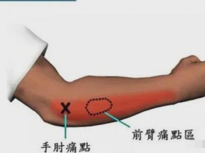 網(wǎng)球肘最怕三個(gè)動(dòng)作，反手拍球/手腕彎曲/提重物/做家務(wù)