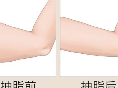 手臂吸脂是指什么