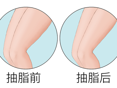 腿部抽脂多久能恢復(fù)