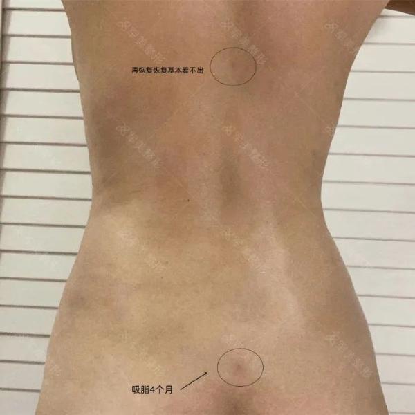 想吸脂后美美穿比基尼，這3大細節要注意