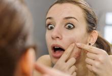 教你2個(gè)天然秘方 解決痘痘的煩惱