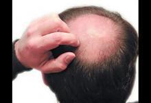 聰明絕頂？禿頂這件事 為何傳男不傳女？