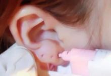 女子路邊攤打耳洞 5年后耳垂變肉瘤