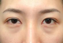 為什么會出現眼袋?怎樣有效去眼袋?