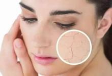  女性皮膚干燥怎么辦？ 如何改善？