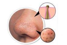 鼻子上的黑頭如何去除 幾個(gè)簡(jiǎn)易方法請(qǐng)收好