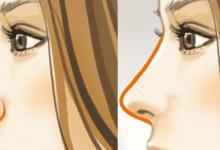 隆鼻多久可恢復(fù)？別忽視這3種后遺癥