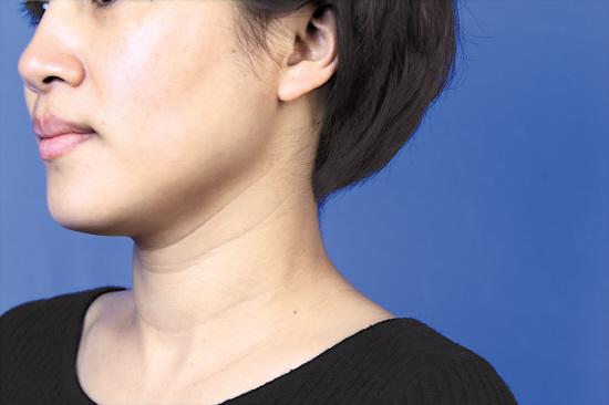 消除頸紋的按摩手法 一學就會