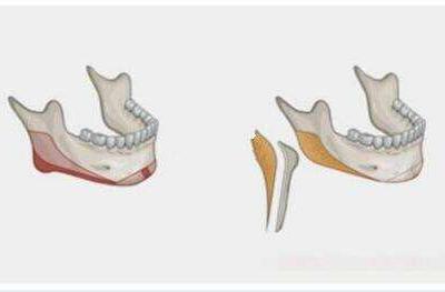 削骨瘦臉 術后3件事一定要做好