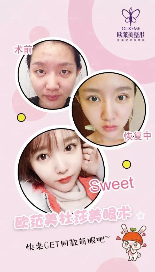 義烏割雙眼皮價格?歐萊美免費(fèi)做雙眼皮招募中！