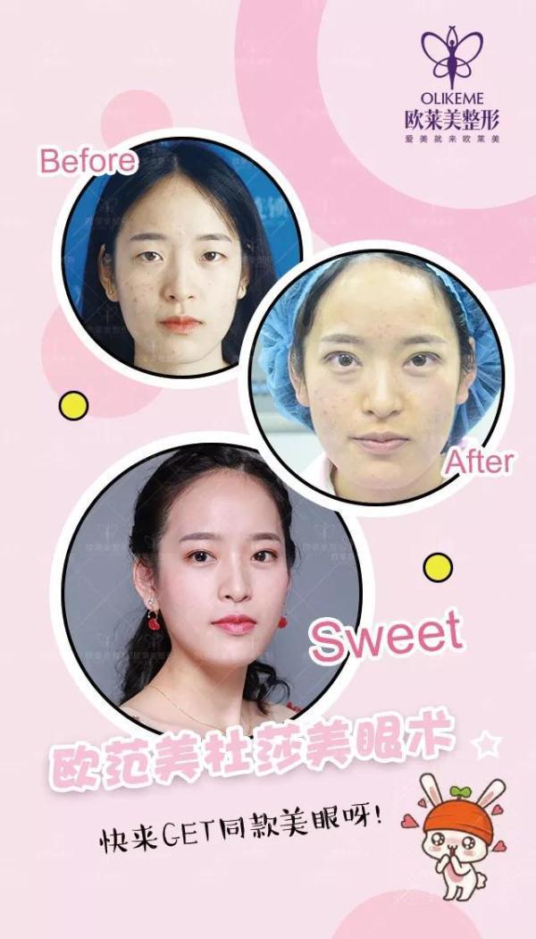 義烏割雙眼皮價格?歐萊美免費(fèi)做雙眼皮招募中！