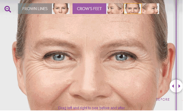 義烏除皺多少錢？歐萊美10000支除皺針免費送！！