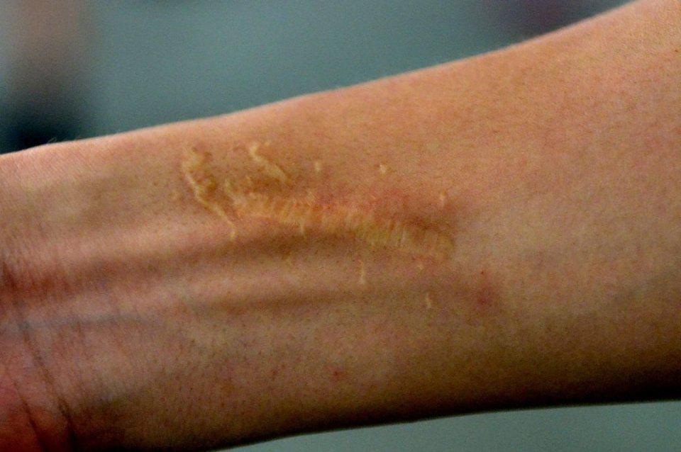 惹人厭的瘢痕 有哪些辦法“抹平”