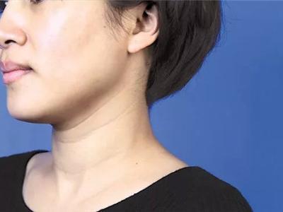 魚尾紋形成的原因是什么?怎樣才能有效去除