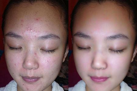 女性長膿包型痤瘡怎么治理，紅腫膿皰護理不當容易留痘疤