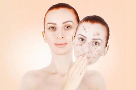 化妝品導致的激素臉，皮膚痤瘡的元兇如何解決