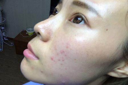 臉上起了密密麻麻的小疙瘩怎么辦，五個方法恢復光滑皮膚
