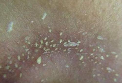 鼻子上擠出來的白色東西是什么？如何正確去除