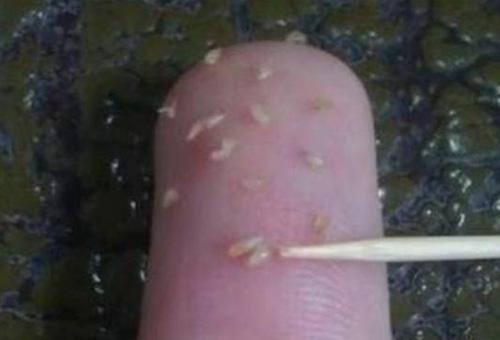 鼻子上擠出來的白色東西是什么？如何正確去除