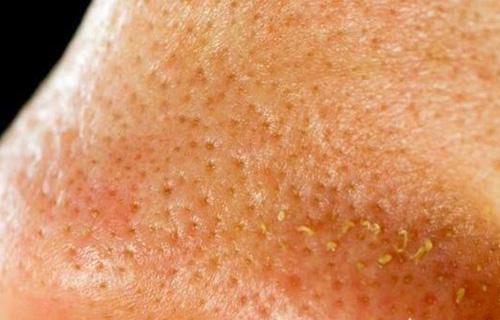 鼻子上擠出來的白色東西是什么？如何正確去除