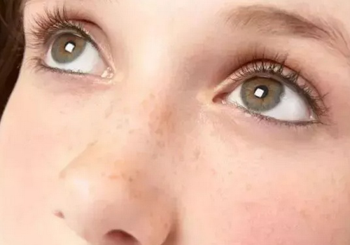 為什么皮膚白的容易長(zhǎng)斑？長(zhǎng)斑該如何護(hù)理？