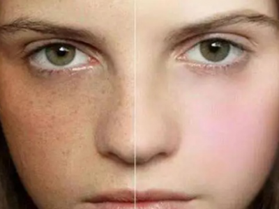 為什么皮膚白的容易長斑？長斑該如何護理？