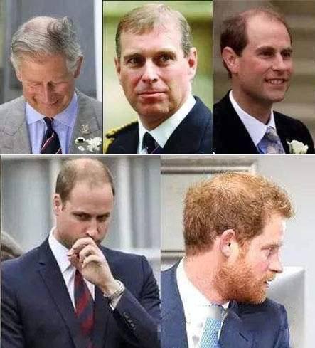 沒有家族脫發(fā)史 我為什么年紀(jì)輕輕也禿了