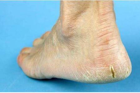 腳后跟干裂起硬皮的原因，女性護理腳部肌膚的正確方法