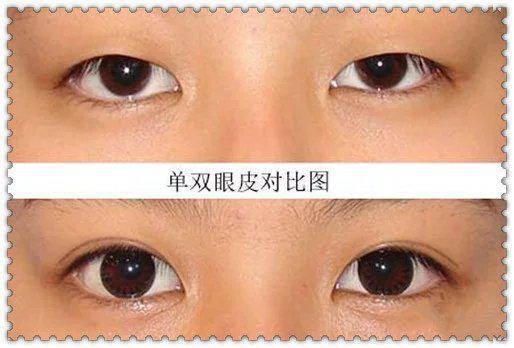 雙眼皮貼久了有害嗎？一天貼多久最適宜？