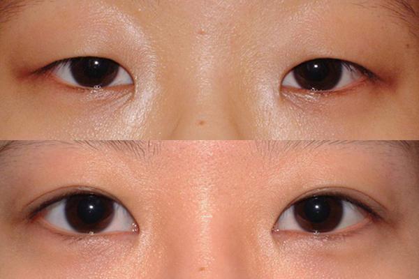 雙眼皮貼什么形狀好用?如何使用?