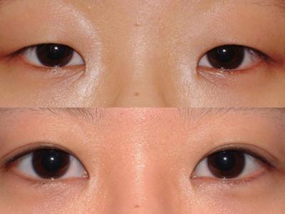 雙眼皮貼什么形狀好用?如何使用?