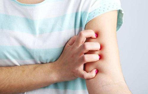 冬季濕疹反復發作怎么辦? 做到這6點遠離濕疹-易網健康養生網 冬季濕疹反復發作怎么辦? 做到這6點遠離濕疹