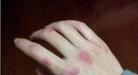 冬天天氣冷長凍瘡怎么辦？6個小妙招教給你