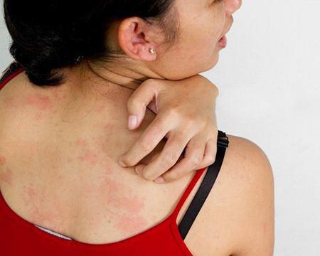 冬季濕疹反復發作怎么辦? 做到這6點遠離濕疹-易網<a href=http://m.henggaotouzi.com/ target=_blank class=infotextkey>健康養生</a>網 冬季濕疹反復發作怎么辦? 做到這6點遠離濕疹