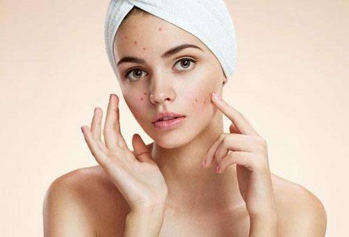 臉上的痘坑能去除嗎 簡單9招讓你擺脫“月球臉”