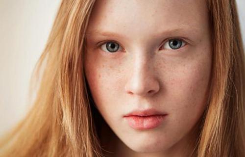 干性皮膚為什么容易長斑？色斑和皮膚干的聯(lián)系