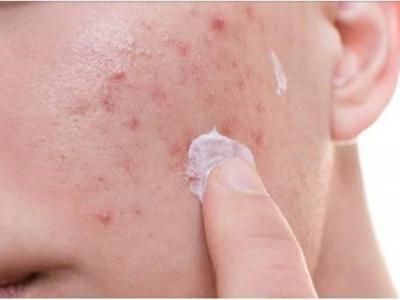 引起額頭長痘的原因,女生做這四件事快速祛痘