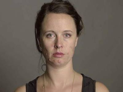 嘴巴周圍長痘的原因，困擾女生的痘痘問題四招解決