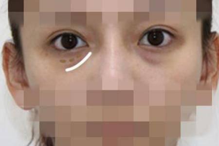 怎樣祛眼袋，讓眼袋消失無蹤的有效妙招