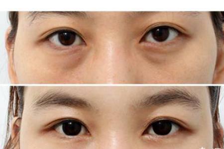 怎樣祛眼袋，讓眼袋消失無蹤的有效妙招