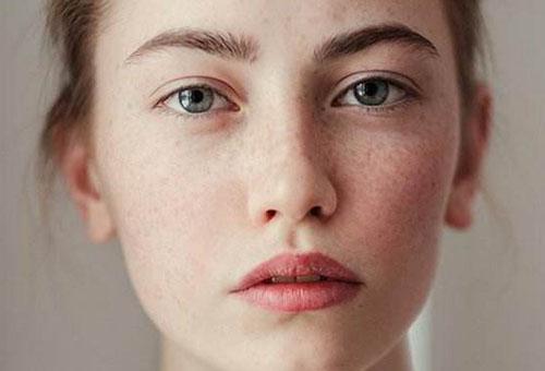 臉上長(zhǎng)黃褐斑怎么祛除 3個(gè)妙招改善黃褐斑問(wèn)題