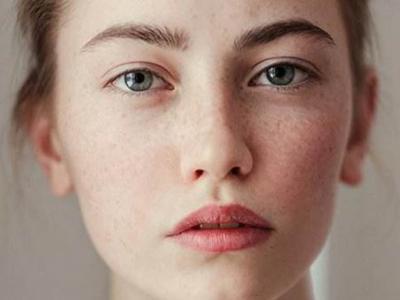 臉上長(zhǎng)黃褐斑怎么祛除 3個(gè)妙招改善黃褐斑問(wèn)題