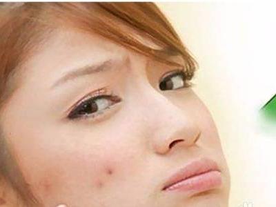 膿包型痤瘡的護理方法，教你六招修復皮膚