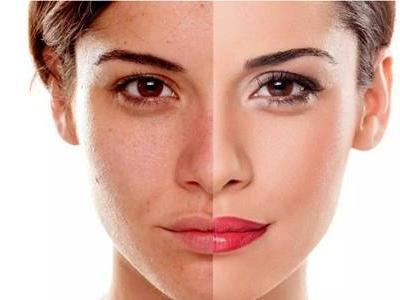 光子嫩膚的危害缺陷，醫美光子嫩膚術后的注意事項