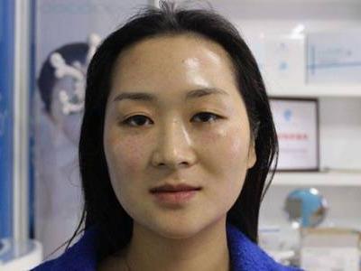 玻尿酸原液的作用和使用方法，女性天天用玻尿酸的后果