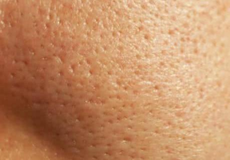 毛孔粗大怎么辦 針對不同情況的毛孔粗大該如何護膚？