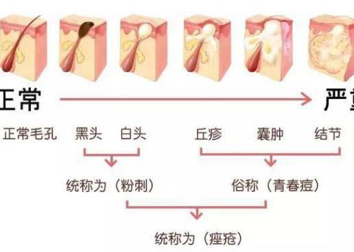 臉上長痘痘怎么調理？做好這三點讓痘痘遠離你