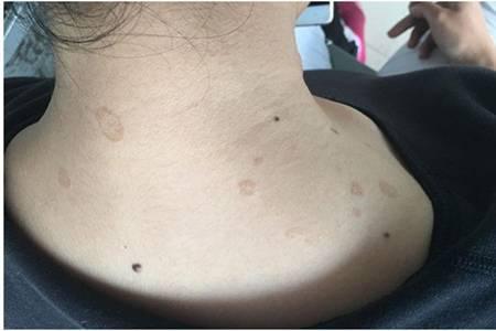 玫瑰糠疹皮膚病怎么引起的，治療方法中忌口這五種食物