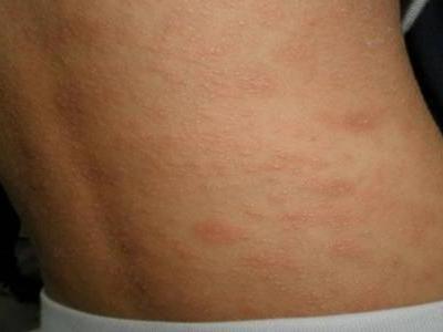 玫瑰糠疹皮膚病怎么引起的，治療方法中忌口這五種食物